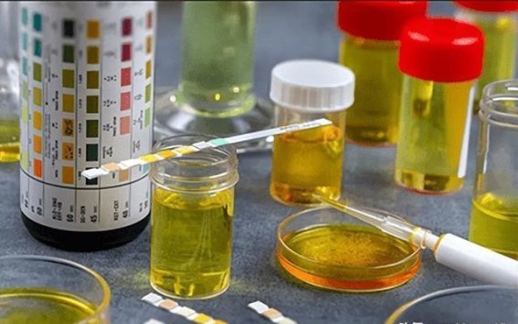 慢性肾脏病患者如何解读24小时尿蛋白定量