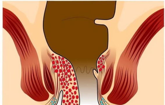 十人九痔，湿热成罪魁，年轻人也不能忽视的健康隐患