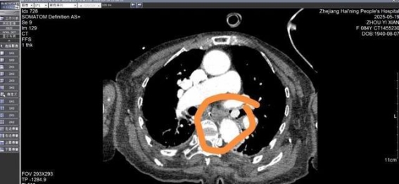 枇杷核误吞引发危机，医生发出警告：老人和儿童尤其要小心