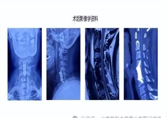 山西首例！山医大二院成功开展颈椎“零切迹”3D打印自稳型人工椎体技术，开启治疗新篇章