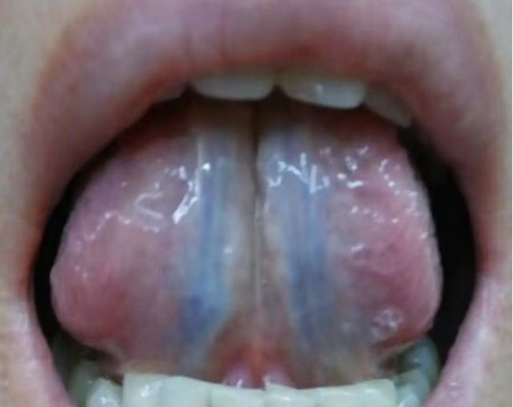 瘀血不能乱用药！三种常见瘀血的成因、症状及调理方法大揭秘