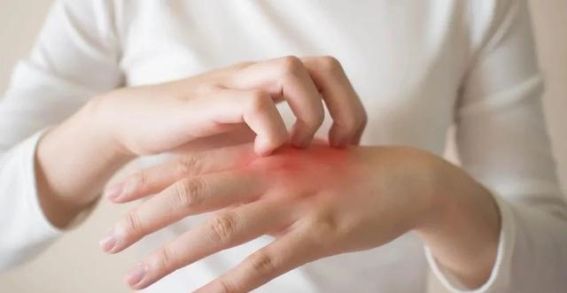 湿疹反复发作，怎样才能迅速缓解？