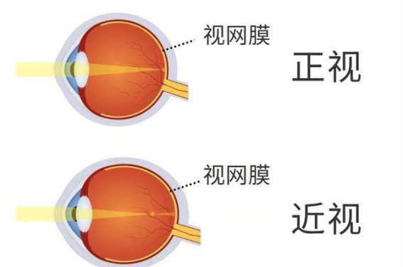 近视度数不断增加，手术矫正不能解决根本问题，视网膜健康需早期关注