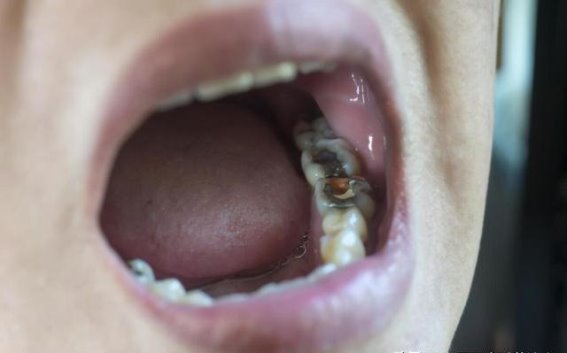 为什么我的牙齿会疼？