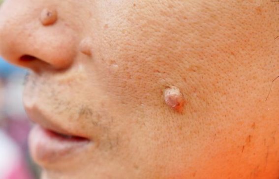 脖子和腋下的小肉粒：这些常见现象你需要了解