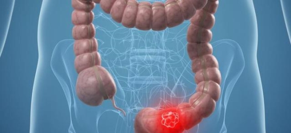 警惕大便变化，结直肠癌早期征兆不容忽视