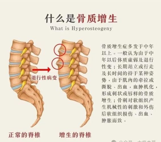 止痉散在治疗骨质增生中的应用与疗效解析
