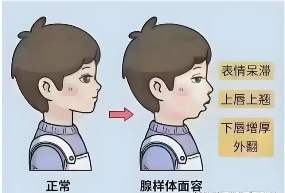 孩子反复鼻塞，别急着动手术！太子参三种搭配帮助腺样体自然消退