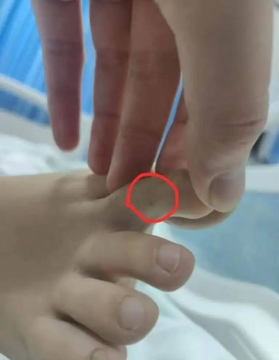 三亚毒蛇咬伤事件：血清短缺与应急体系的隐忧