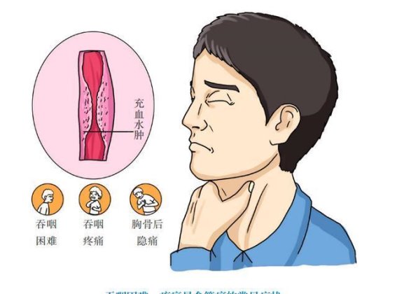 夫妻双双食管癌，警惕这些日常饮食习惯的潜在危害