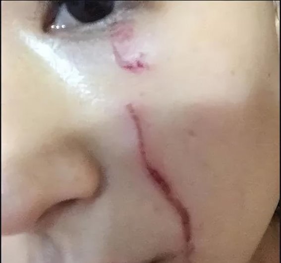 抓伤后为什么会发黑？有效的护理与治疗方法